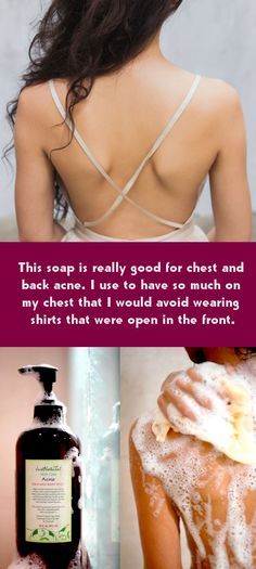 This acne body wash soap is really good for chest and back acne. I use to have s...
