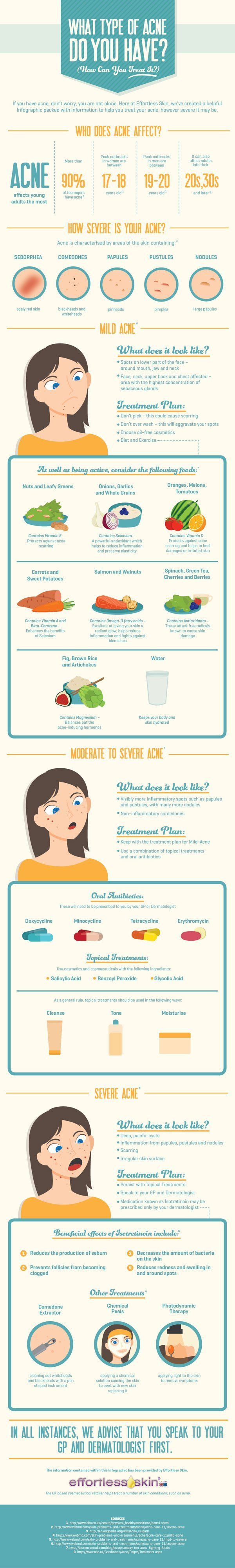Different Types Of Acne & How To Get Rid Of It, check it out at makeuptutorials....